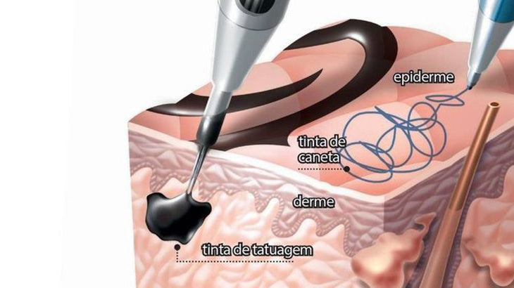 【医師監修】アトピー肌でもタトゥーは入れられる?リスクと注意点を解説